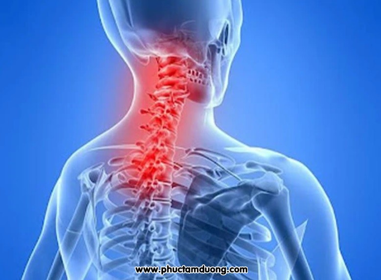 ĐIỀU TRỊ THOÁI HÓA CỘT SỐNG CỔ BẰNG YHCT