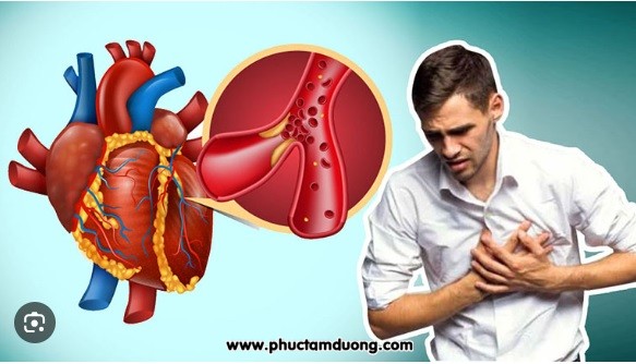 LÀM GÌ SAU NHỒI MÁU CƠ TIM (NMCT)